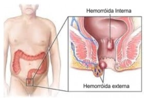 Hemorroidas - Internas e Externas